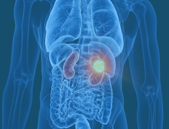 Kidney Cancer Location