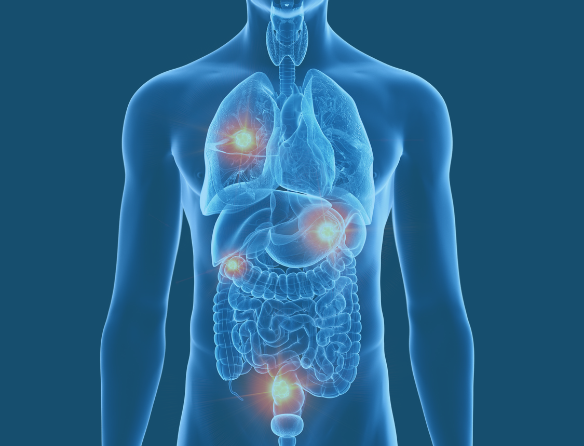 Metastatic Cancer