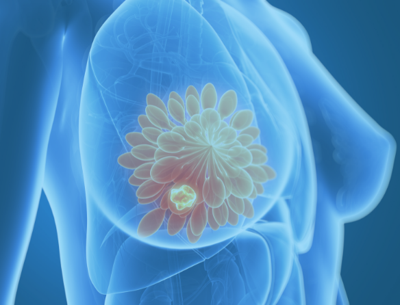 Breast Cancer Location