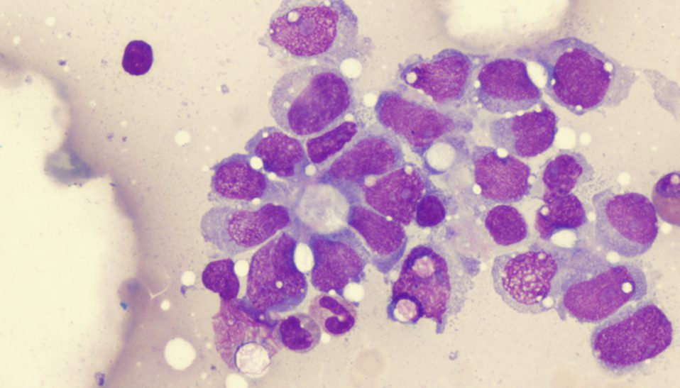 Sarcoma: rare disease day
