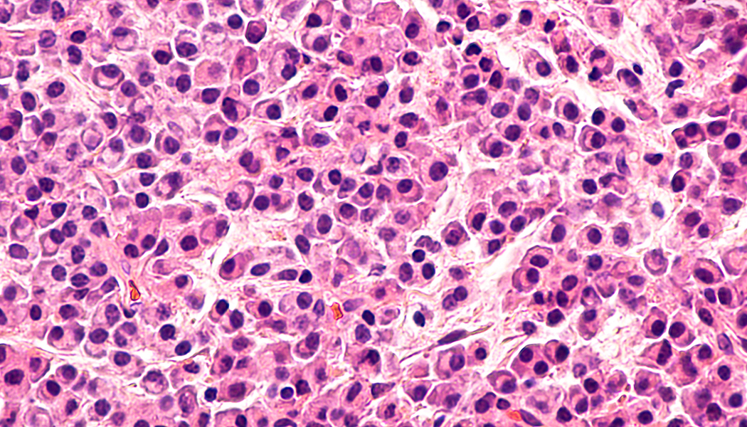 Multiple Myeloma Multiple Myeloma