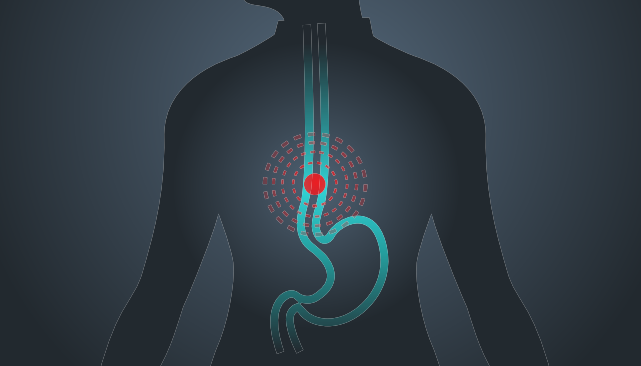 New Test Developed for Pre-Cancerous Barrett’s Esophagus shutterstock image
