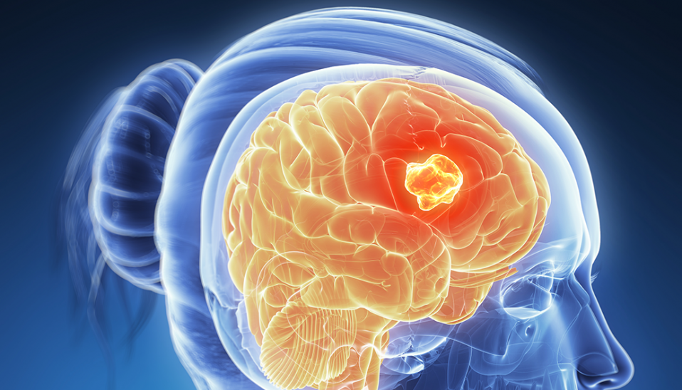 Brain Cancer Awareness