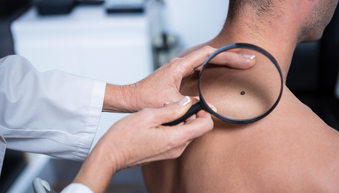 Skin-Cancer-Awareness-Month-image
