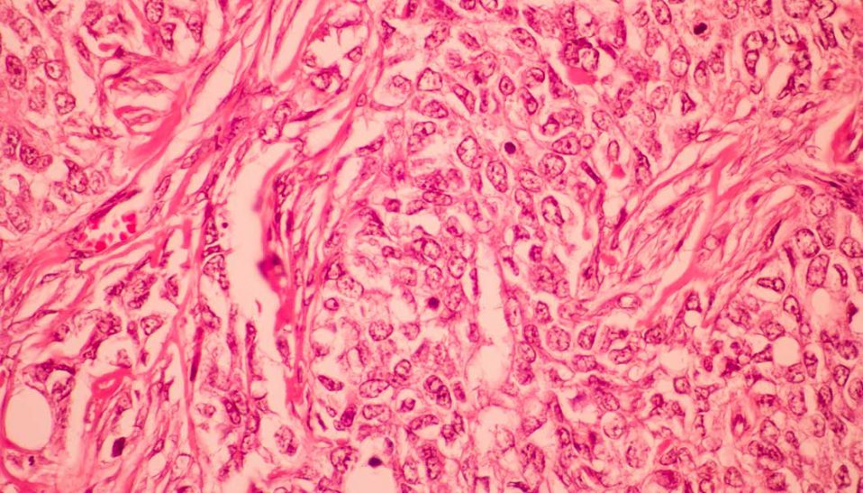 breast cancer metastasis