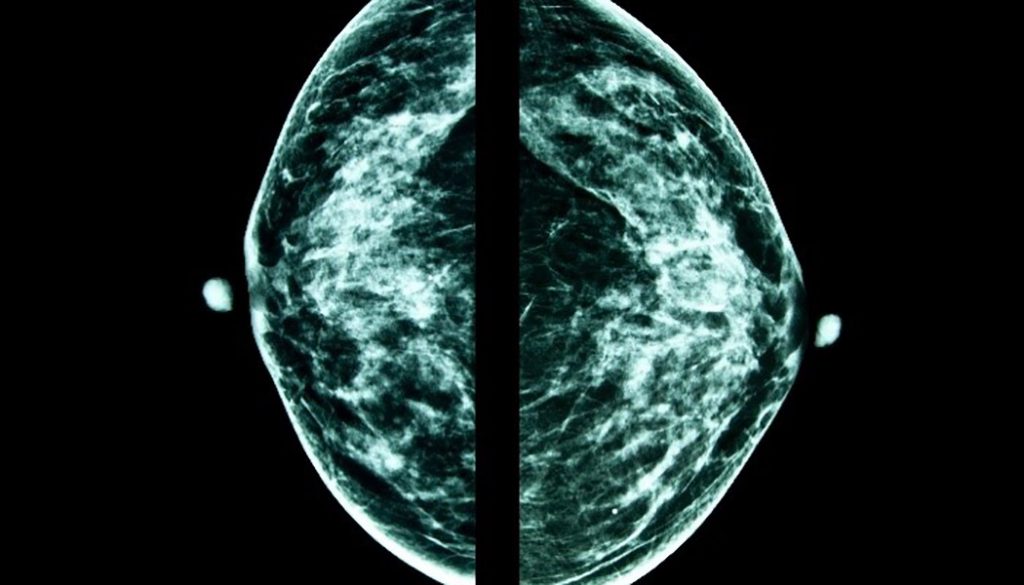 Remember to schedule your mammogram this October Mammogram image