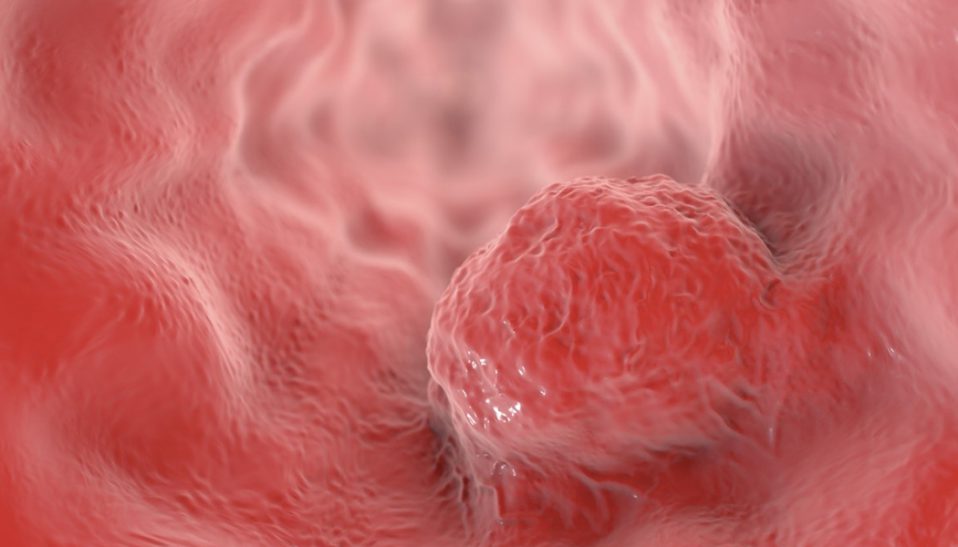 Esophageal Cancer