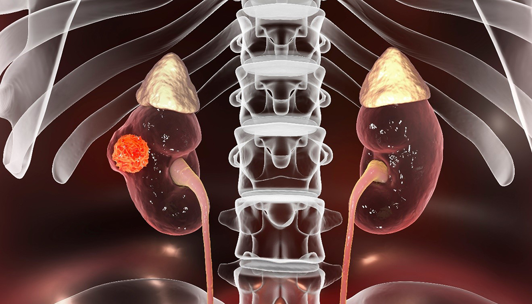 New molecule shows further promise in viability of a blood test for cancer detection kidney cancer