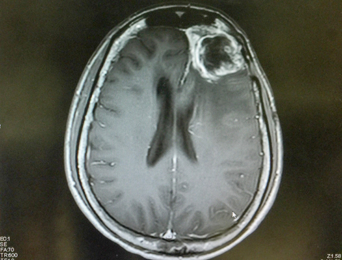 glioblastoma