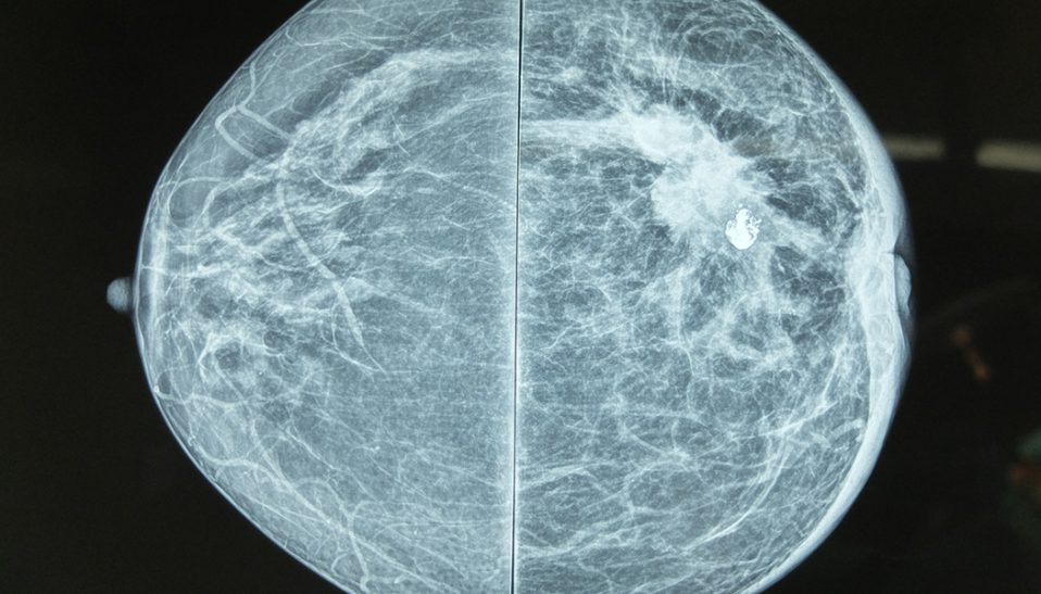 Mammogram