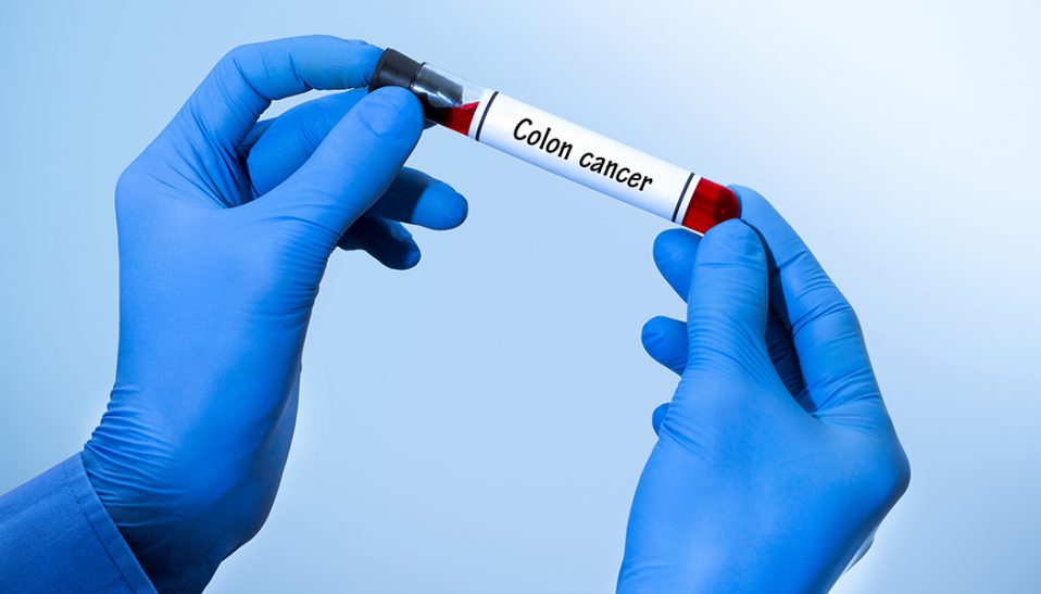 Colorectal Cancer Prevention