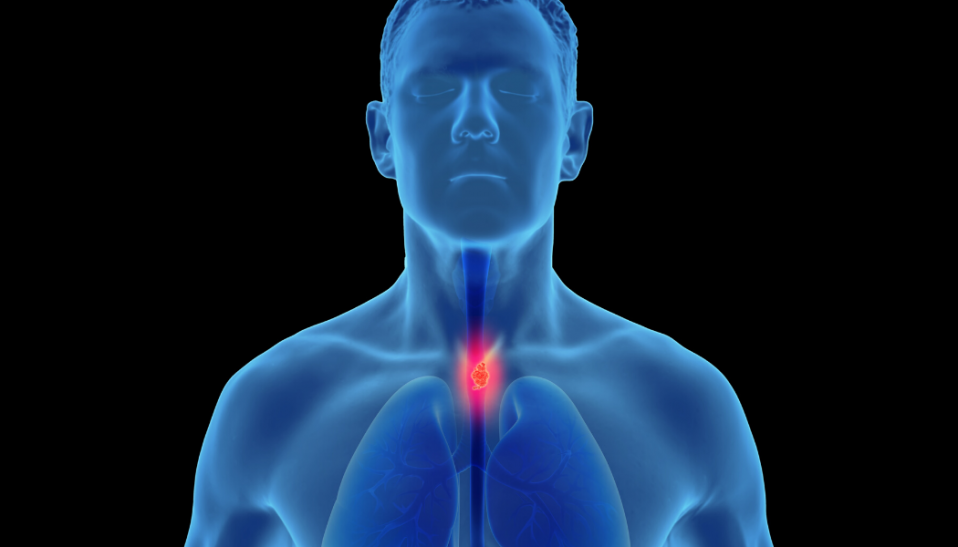 Esophageal Cancer Awareness