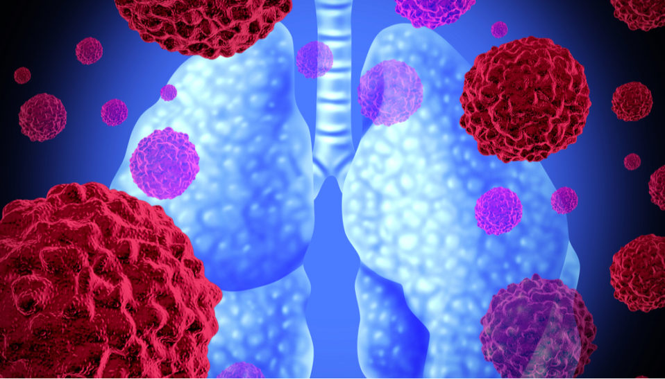 SCLC vs NSCLC