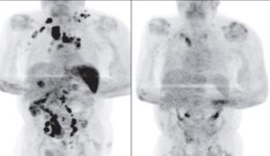 lymphoma covid in post Lymphoma Scan post COVID-19