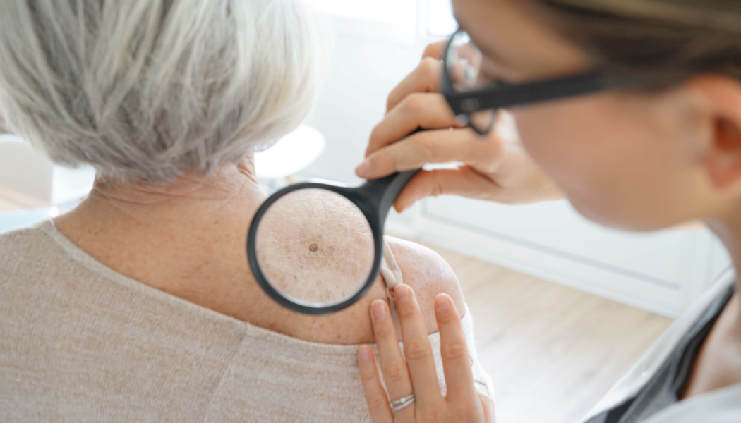 melanoma skin cancer melanoma skin cancer